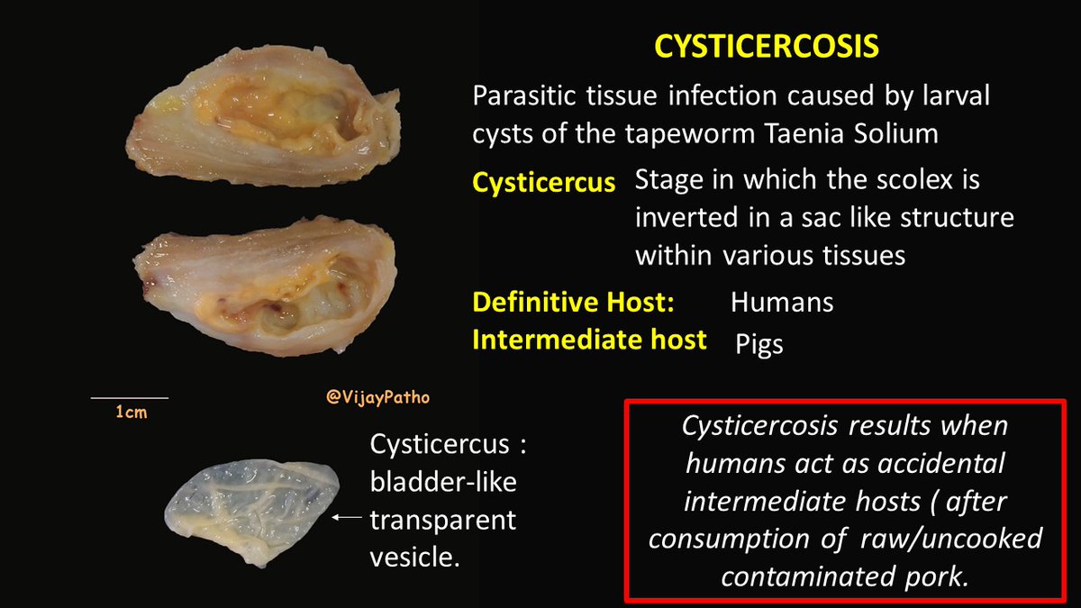 VijayPatho's tweet photo. @DrAhmedKalebi @TheKarenPinto @kriyer68 @vi_monappa @Thejaspatho @luishcruzc @DrGeeONE @pathridle_susan @smlungpathguy @ParasiteGal @DrRolaAli @suraksharaob @tralimiguel @ariella8 @DrFNA @edusqo @lara_pijuan @PrasadCsbr @Path_Matt @DrSamreenfatima @Swathiprabhu5 @adi_agnihotri FINAL DIAGNOSIS : CYSTICERCOSIS. This was within the muscle. Find the images below. @DrAhmedKalebi @TheKarenPinto #grossognosis #pathbugs #pathology #crittersontwitter @vi_monappa @luishcruzc #pathology #pathboards @smlungpathguy https://t.co/NwDfOxr7xI