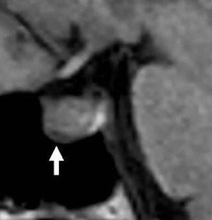 vmargar's tweet photo. #FOAMrad #neurorad 
Prominent Inferior Intercavernous Sinus (IICS): A Sign of Intracranial Hypotension (SIH)

Dilatation of the IICS is frequently associated with SIH, although it can also be found in the healthy adult as a normal anatomic variant. https://t.co/qyx2XG44AW