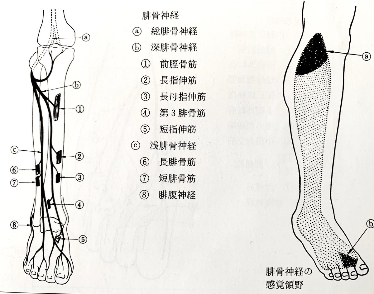 腓骨神経麻痺