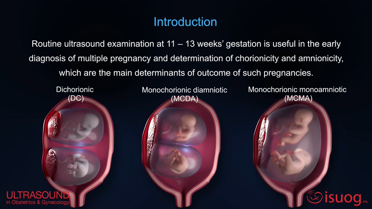 ISUOG's tweet image. Watch the new #UOGJournal video abstract on the outcome of twin pregnancy with two live fetuses at 11–13 weeks’ gestation, by Prof. Nicolaides’ group here: isuog.org/resource/uog-v… #ISUOG 

Read the free-access article here: bit.ly/2TMIhj3 #LoveUltrasound