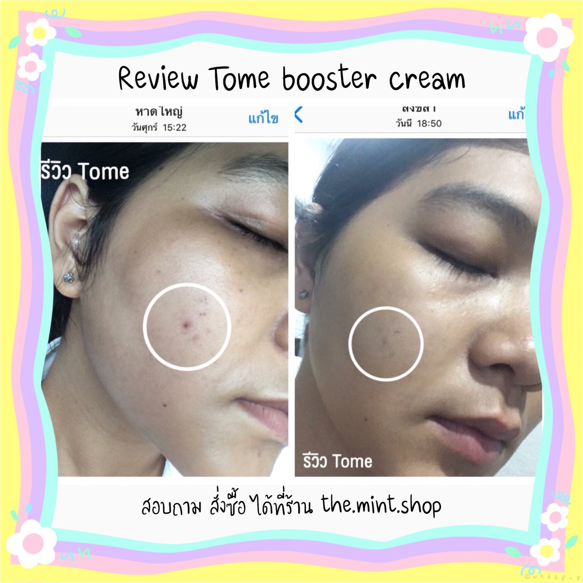 มันม่วง49 | โทเมะ99 • หน้าใส ลดสิว • tweet media