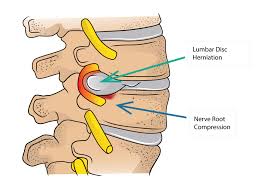 DrSusmitNaskar's tweet photo. ✔️ Artificial #Spine #LumbarDisc Replacement in India
▫️
▫️
✔️ Are you suffering from spinal or any other related pain? Request an appointment with Dr. #SusmitNaskar today. Visit https://t.co/bH9ibCgx1v for appointment.
▫️
▫️
✔️ #SpineLumbarDisc https://t.co/Dn8O4vlrPh