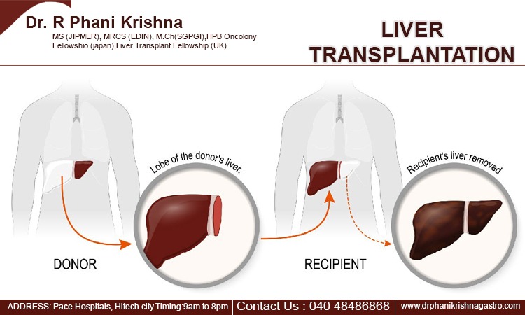 Реципиент трансплантация. Трансплантация печени. Трансплантация части печени. Трансплантация печени и донор. Ортотопическая трансплантация печени.