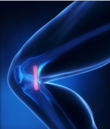 DrNikhilVerma's tweet photo. Did you know that unlike the #ACL the #MCL is able to heal on its own after injury, however, some tears may be so severe that they require surgery to repair or reconstruct the #tornMCL
Learn more here: https://t.co/u0qn549WoH https://t.co/jPzgwgnhUy