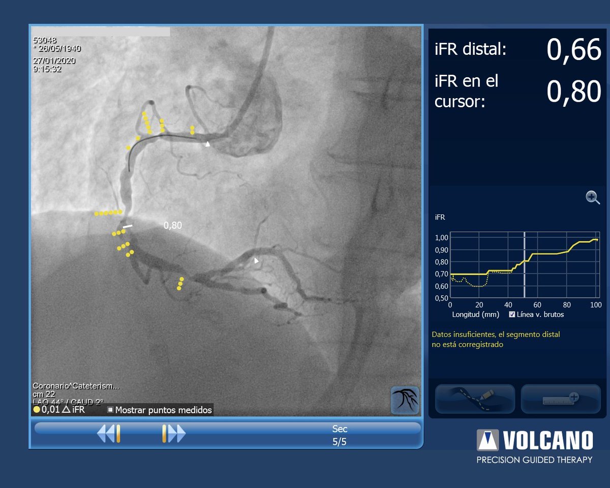 Precision #PCI with #Volcano #SyncVision Guidance System at <a href="/INC_CathLab/">INC Cath Lab</a> 

#CardioTwitter #RadialFirst #IVUS #iFR #FFR #CTO