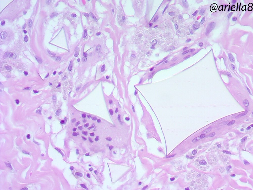 ariella8's tweet photo. #Pathpuzzler #Pathcasetosolve #Pathology #Medicalforeignbodies #infectiousdiseases As promised here are more pics ,you got some clues already if you want some additional info you can ask one question,to know where we are 😁 https://t.co/iscljJhmkH
