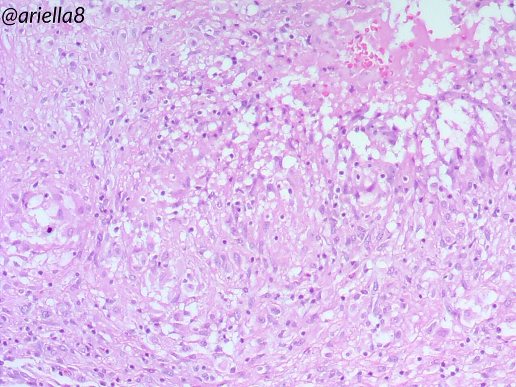 ariella8's tweet photo. #Pathpuzzler #Pathcasetosolve #Pathology #Medicalforeignbodies #infectiousdiseases As promised here are more pics ,you got some clues already if you want some additional info you can ask one question,to know where we are 😁 https://t.co/iscljJhmkH