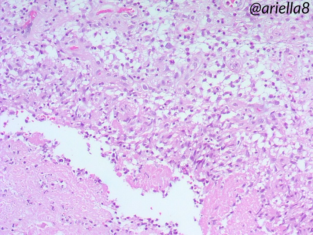 ariella8's tweet photo. #Pathpuzzler #Pathcasetosolve #Pathology #Medicalforeignbodies #infectiousdiseases As promised here are more pics ,you got some clues already if you want some additional info you can ask one question,to know where we are 😁 https://t.co/iscljJhmkH