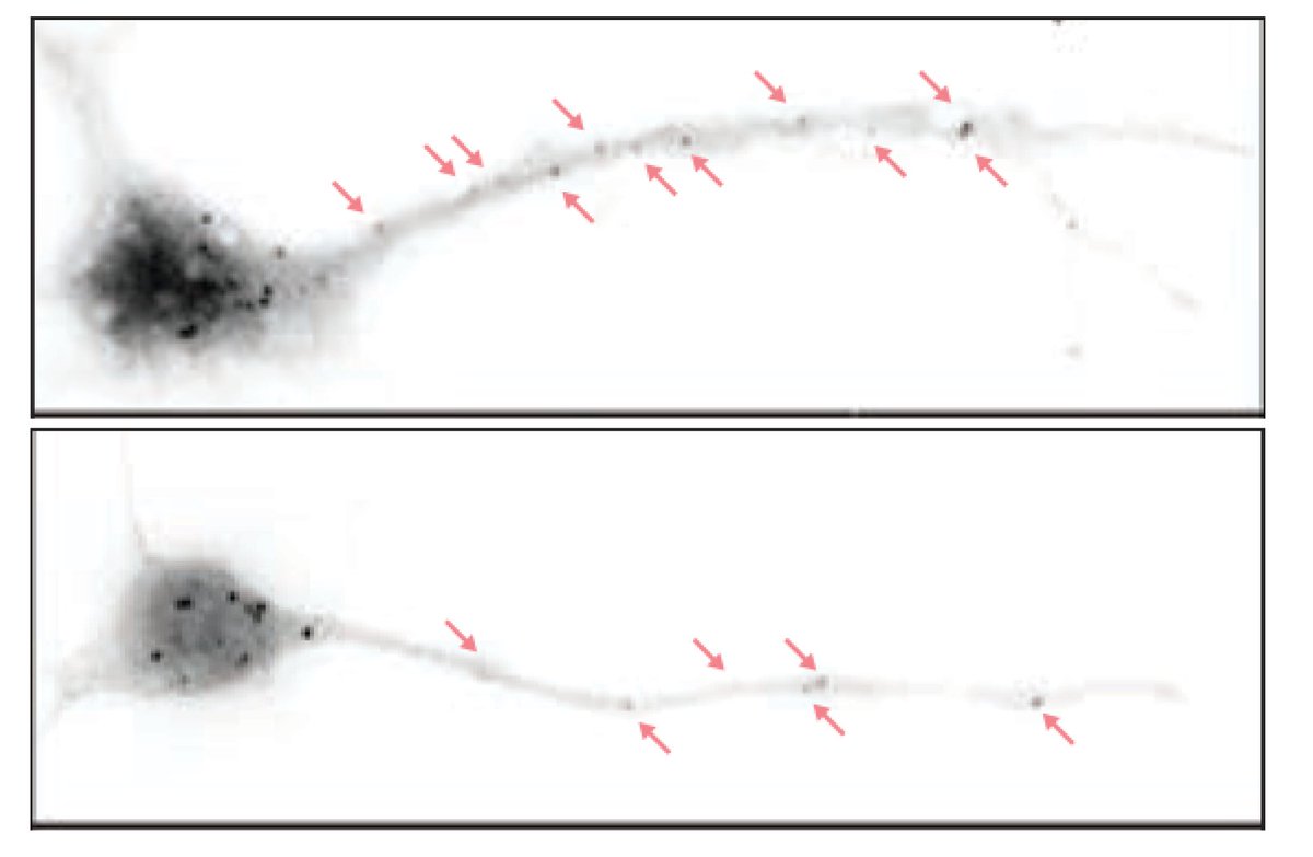 Hippocampal neurons from a normal mouse (above) and a mouse bred to lack the eIF4G microexon (below). The latter contains fewer particles that represent paused protein synthesis machineries. Ramped up synthesis in neurons leads to disrupted brain waves and autistic-like behaviors as well as cognitive deficits down the line