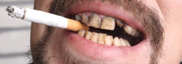 This is a photo of teeth stain by tobacco.