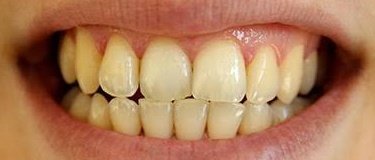 This is a photo is teeth stain by wine.