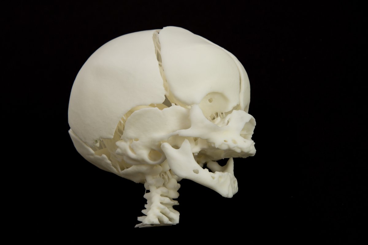 #3Dprinting #medical models can reduce surgical times by over 60 minutes, greatly improving outcomes for patients &amp; reducing the cost of expensive procedures.

New press release from <a href="/Henkel/">Henkel</a> &amp; <a href="/NewPro3D/">NewPro3D</a> demonstrates the opportunity. 

 henkel.com/press-and-medi…