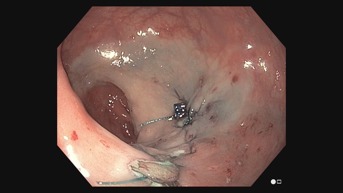 Ferga Gleeson (@fergagleeson) on Twitter photo A <a href="/MayoClinic/">Mayo Clinic</a> <a href="/MayoClinicGIHep/">Mayo Clinic Gastroenterology & Hepatology</a> first 🎉 gastroenterologist #LMWKS performed a robotic assisted endoscopic resection of a distal rectal lesion using <a href="/Medrobotics/">Flex</a> system 👌He’s a class act!! <a href="/DarrellPardi/">Darrell Pardi</a> <a href="/Dr_Vijay_Shah/">Vijay Shah</a> A <a href="/MayoClinic/">Mayo Clinic</a> <a href="/MayoClinicGIHep/">Mayo Clinic Gastroenterology & Hepatology</a> first 🎉 gastroenterologist #LMWKS performed a robotic assisted endoscopic resection of a distal rectal lesion using <a href="/Medrobotics/">Flex</a> system 👌He’s a class act!! <a href="/DarrellPardi/">Darrell Pardi</a> <a href="/Dr_Vijay_Shah/">Vijay Shah</a>
