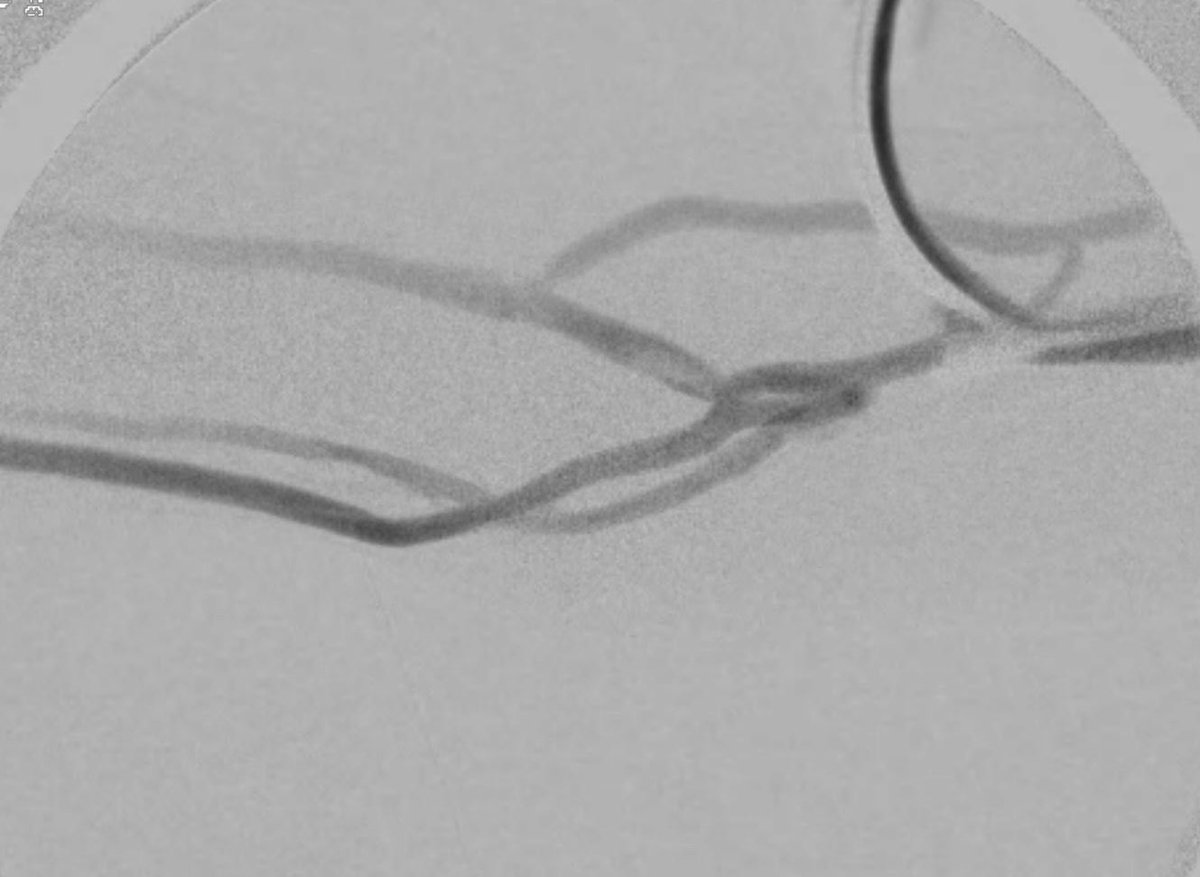 NMawlaMD's tweet photo. Quick Tip. If a forearm access angiogram lights up the brachial veins, it’s likely through the perforator. Consider that for a future endoAVF option. #PreservethePerf #endoAVF #pAVF #percavf #ellipsys #wavelinq @ASDINNews @wasse_m @aishaikh @Alejand26303992 https://t.co/hdnUvCJRqM