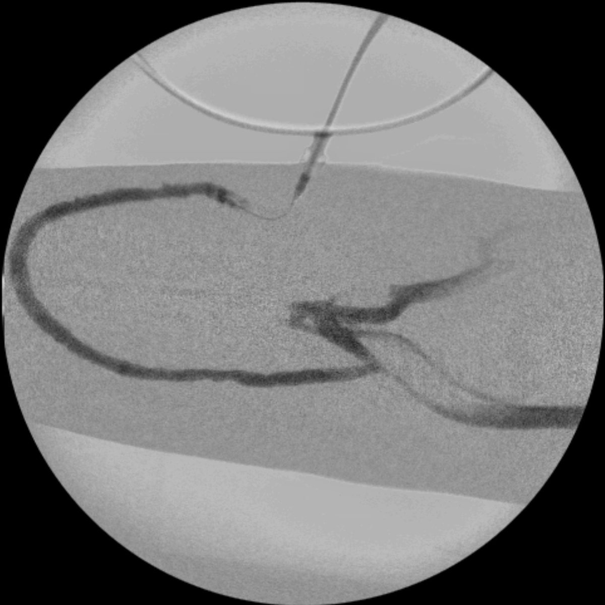 NMawlaMD's tweet photo. Quick Tip. If a forearm access angiogram lights up the brachial veins, it’s likely through the perforator. Consider that for a future endoAVF option. #PreservethePerf #endoAVF #pAVF #percavf #ellipsys #wavelinq @ASDINNews @wasse_m @aishaikh @Alejand26303992 https://t.co/hdnUvCJRqM