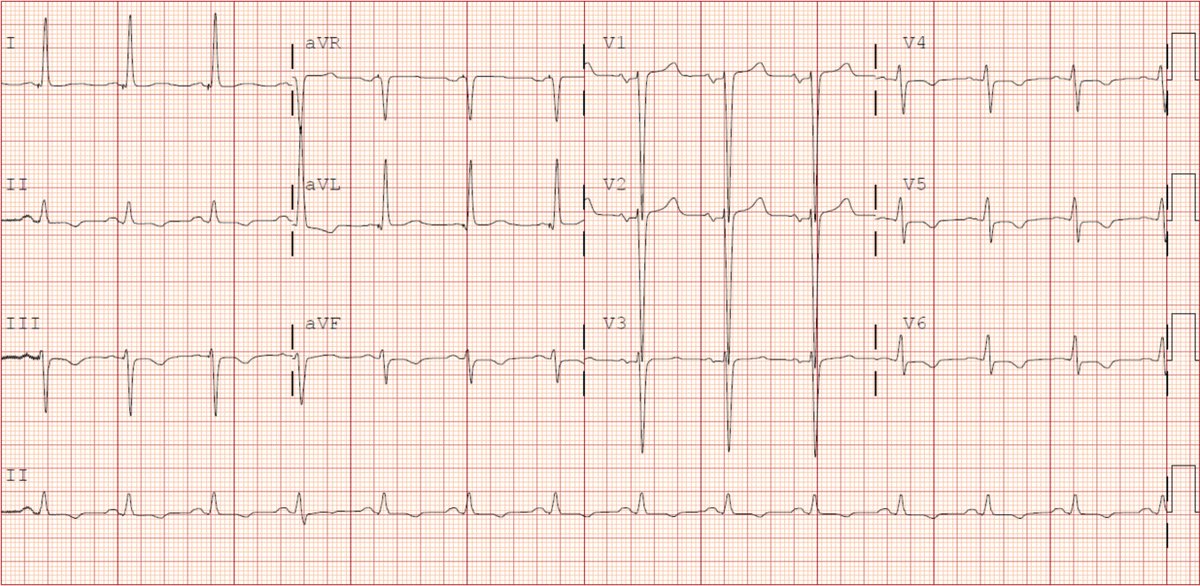 Check out circ EP challenge of the week ECG ahajournals.org/circep/challen… @CirculationEP #circEPchallenge