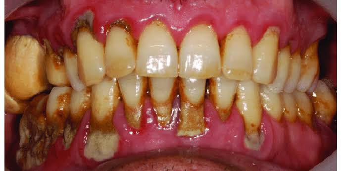 Image showing calculi/tartar
