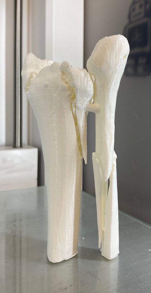 3d_maranon's tweet photo. 3D-printed model used as a template for treating a patient suffering from a suprasindesmal fracture (ankle fracture) above the syndesmosis level on the right foot which joins the ankle to the tibia and fibula leg bones. https://t.co/iJHOlfVmF2