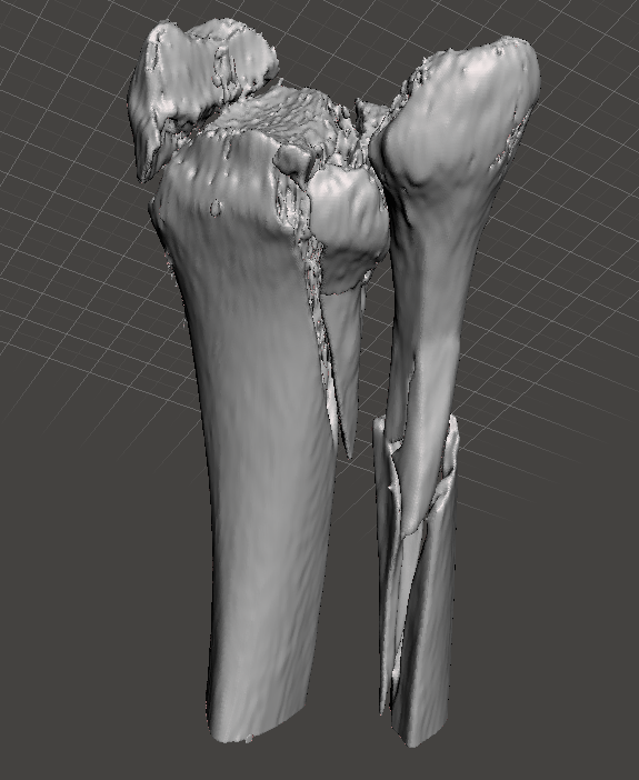 3d_maranon's tweet photo. 3D-printed model used as a template for treating a patient suffering from a suprasindesmal fracture (ankle fracture) above the syndesmosis level on the right foot which joins the ankle to the tibia and fibula leg bones. https://t.co/iJHOlfVmF2
