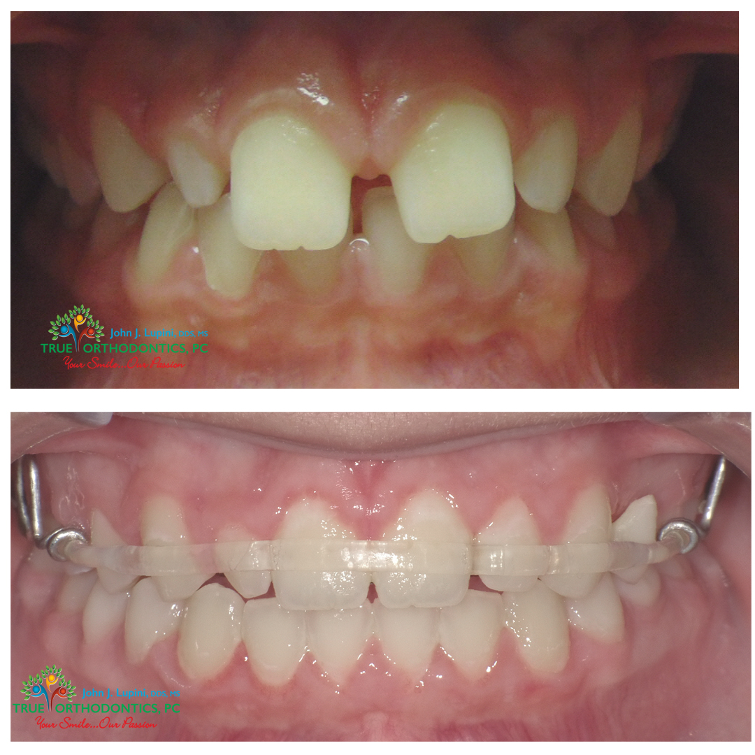 TrueOrthodontic's tweet photo. Check out Harmony's before and after. She was a Class 1 Malocclusion and was missing her permanent molars on her left side. She had a 3mm diastema. We were able to give her a smile she has always wanted. Leaving a pontic in the place of her upper molar for future implant. https://t.co/5DMLrzhRH2