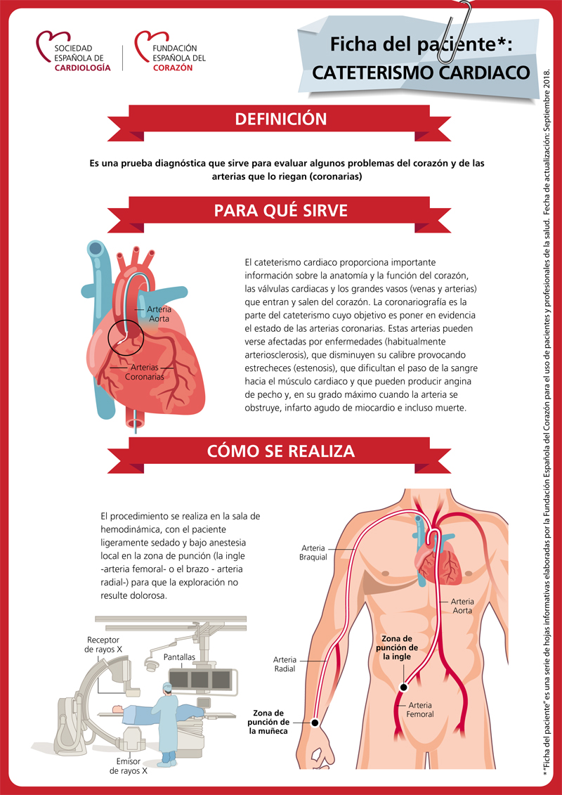 como es un cateterismo en el corazon como es un cateterismo en el corazon