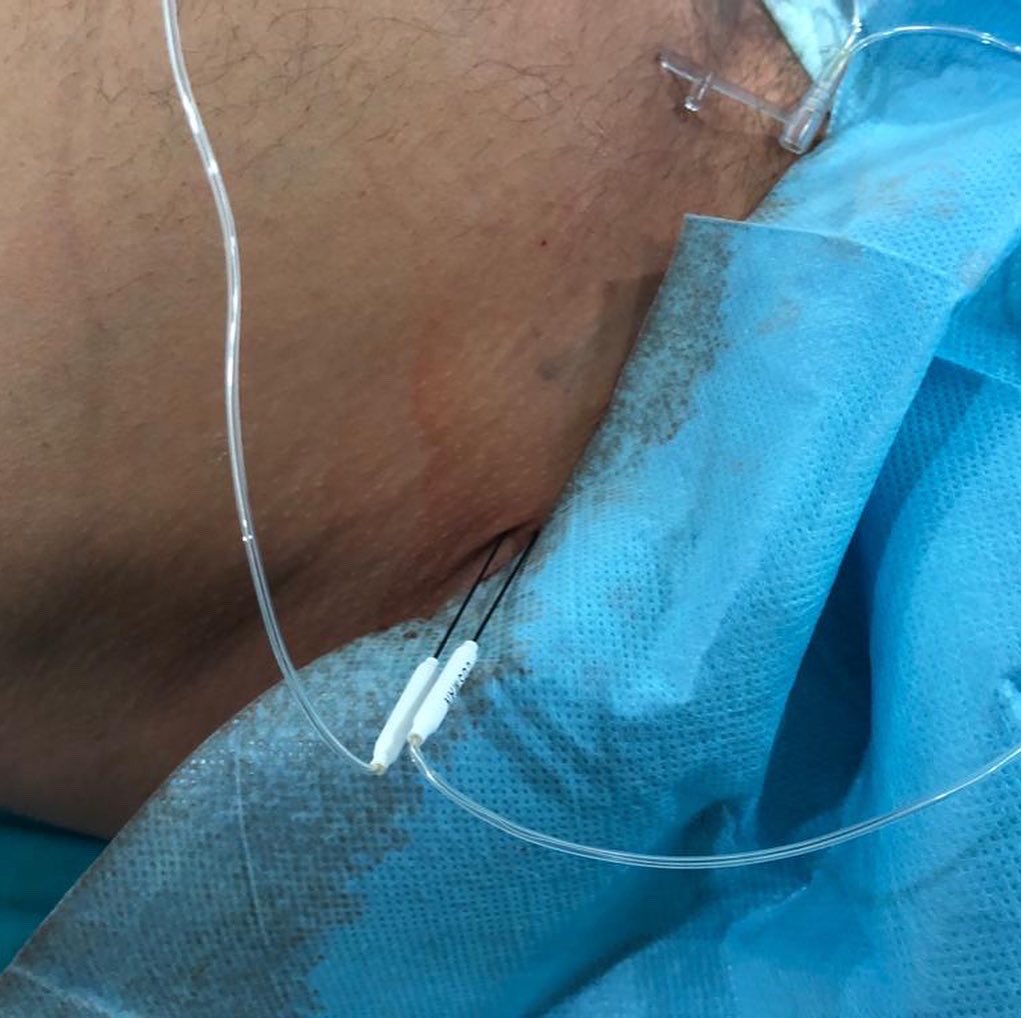 herrero_dr's tweet photo. Conventional radiofrequency of articular femoral branches to treat lateral hip pain, using bipolar mode guided by ultrasound and fluoroscopy #chronicpain #hippainrelief #ultrasound #fluoroscopy #painblock https://t.co/mz5pL8lDV2