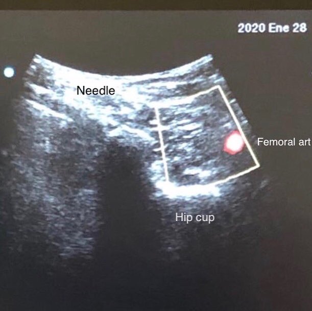 herrero_dr's tweet photo. Conventional radiofrequency of articular femoral branches to treat lateral hip pain, using bipolar mode guided by ultrasound and fluoroscopy #chronicpain #hippainrelief #ultrasound #fluoroscopy #painblock https://t.co/mz5pL8lDV2