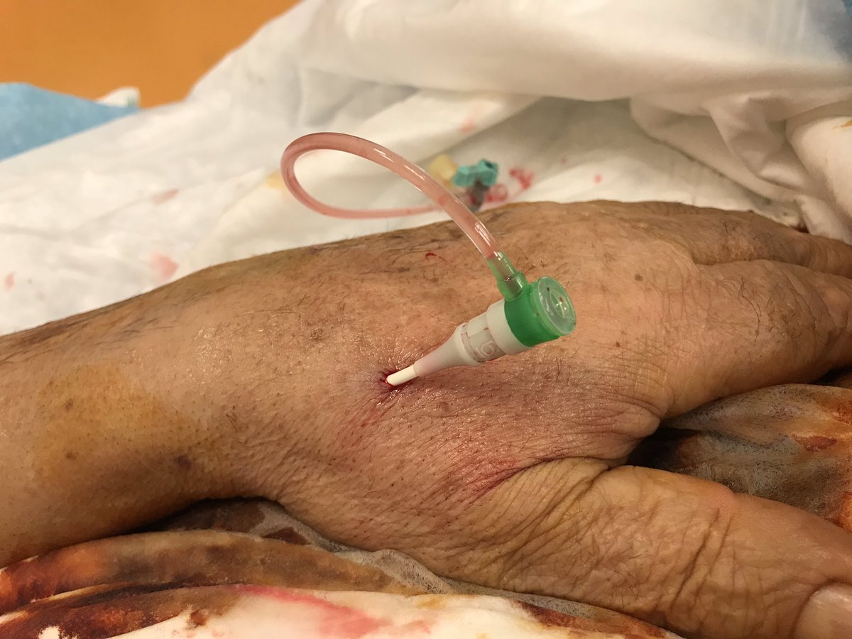 alessio_lamanna's tweet photo. New closure device for #Ldtri (from Merit) tested today. Very easy and effective! #Radialfirst @evandrofilhobr @DFCapodanno @giuseppe_ando @lorenzo2509 https://t.co/EFGdrWDJQY
