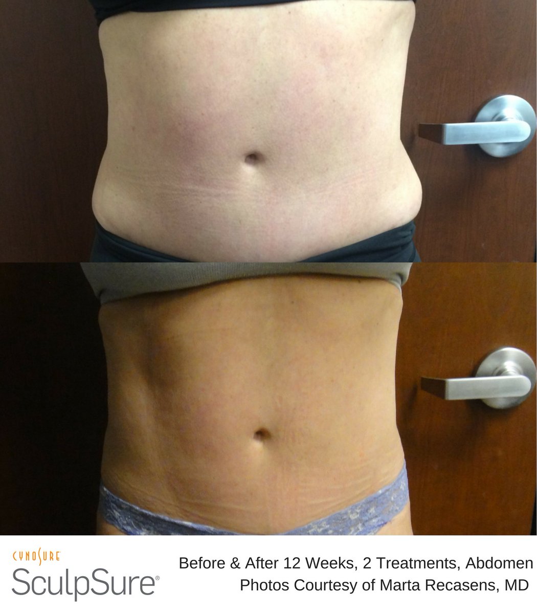 martasmedispaMD's tweet photo. SculpSure B&amp;A Photos. https://t.co/SY82RBetC2