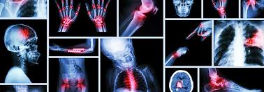 JdentoralSci's tweet image. Recently published: Critical role of Rehabilitation in Global Health: The Next Step 
Link: maplespub.com/journal/Archiv…
#Submissionopen #WednesdayThoughts 
Contact: rehabilitation@mapsci.org
Journal Scope: maplespub.com/journal/Archiv…
#rehabilitation #Neurology #Orthopaedic #physiotherapy