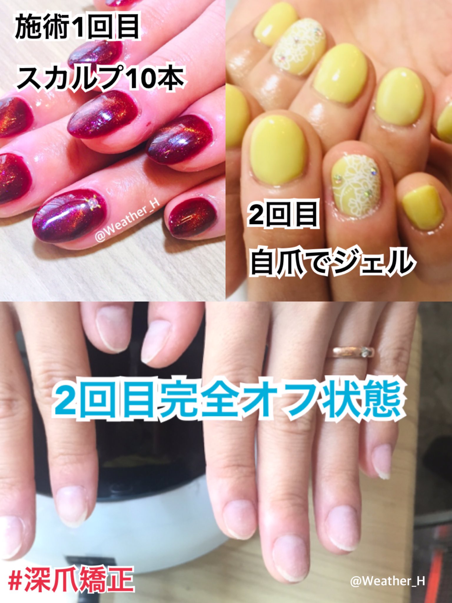天候さん 深爪矯正ネイリスト No Twitter 咬爪症矯正 施術2回目 自爪にジェルが可能だったので スカルプ全オフしました ワンカラーコース 3 300円 税込 咬爪症ネイル 咬爪症矯正 深爪 深爪矯正 ネイルサロン ジェルネイル プライベートサロン 前橋 天候さん 深爪矯正ネイリスト No Twitter 咬爪症矯正 施術2回目 自爪にジェルが可能だったので スカルプ全オフしました ワンカラーコース 3 300円 税込 咬爪症ネイル 咬爪症矯正 深爪 深爪矯正 ネイルサロン ジェルネイル プライベートサロン 前橋