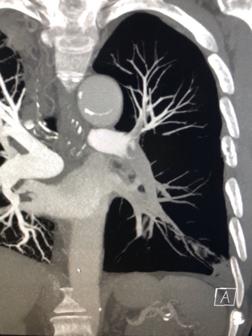UCD_IR's tweet photo. First case with new @InariMedical T24 Flowtriever. Large clot burden in single lung transplant. No tPA. @MBMD_IR @chrisjtyler @PERTConsortium #irad https://t.co/9rDzdMcXpv