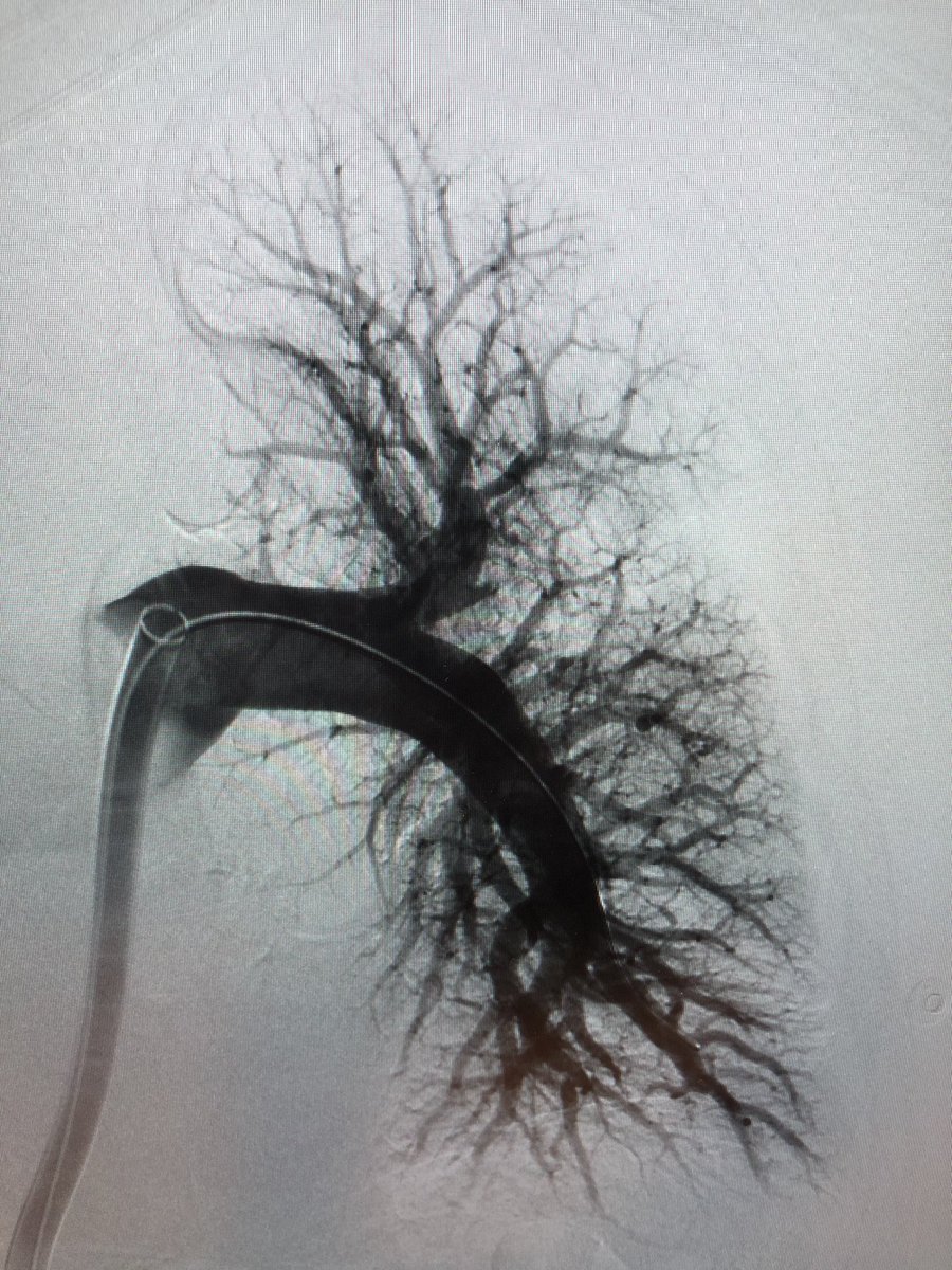 First case with new @InariMedical T24 Flowtriever. Large clot burden in single lung transplant. No tPA. @MBMD_IR @chrisjtyler @PERTConsortium #irad