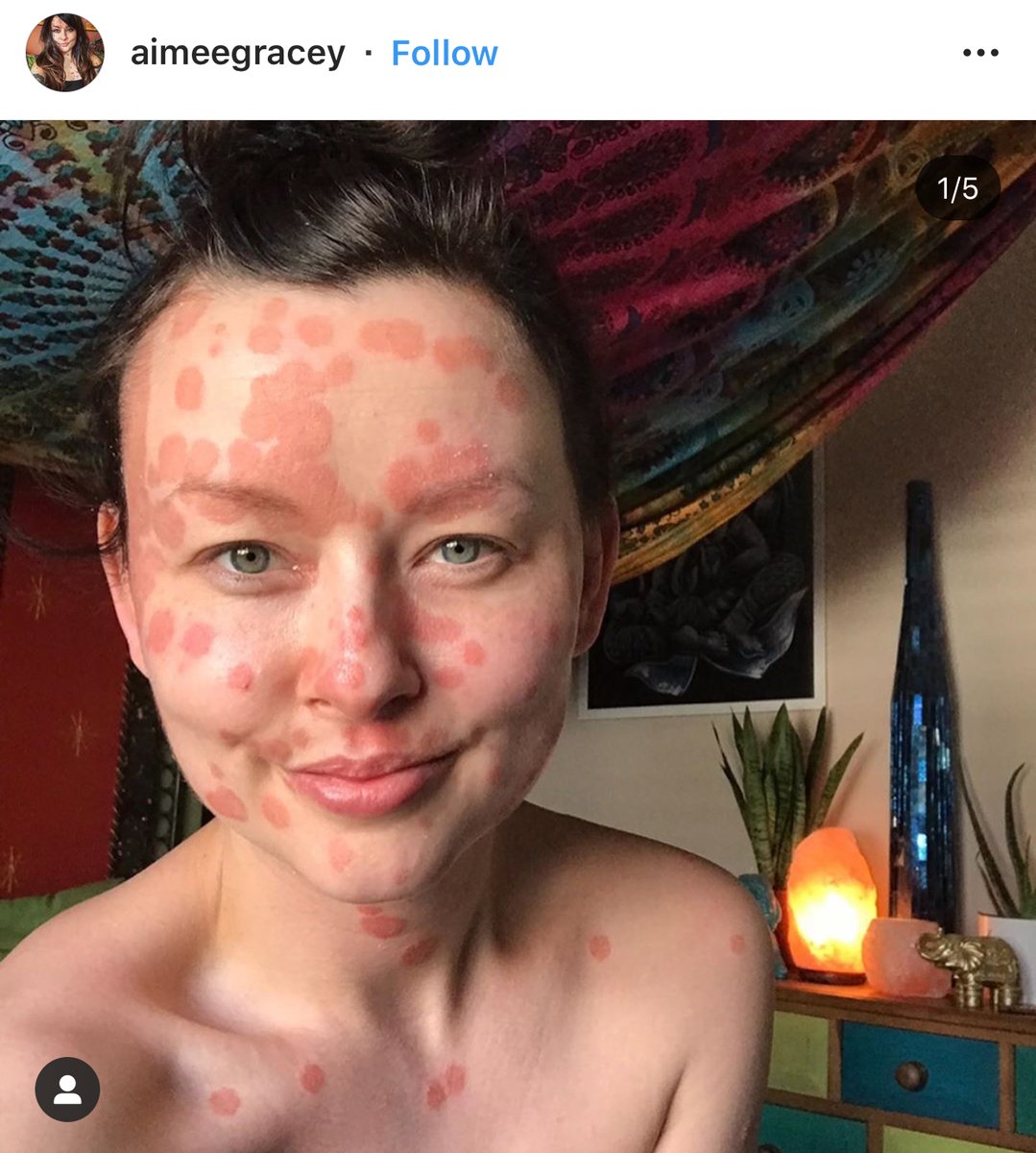 accionpsoriasis's tweet photo. #PsoriasisWorldWide 🌍 Hoy recogemos dos sonrisas: la de Aimee y Molly, que comparten su #psoriasis en instagram bajo la etiqueta #psoriasiswarriors (que significa "Guerreros de la psoriasis" ) 💪 ¡¡GRACIAS POR NORMALIZAR!! 😀 https://t.co/S3RuuFZFTg