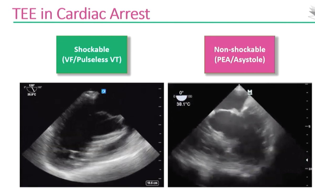 FOAMecmo's tweet photo. Critical care #echocardiography #TTE perceived easier/less invasive/more available, advantage for #TEE? complementary/live-saving ie CA trauma #ECMO #ECPR @docsanga @Smart_Meeting_M video https://t.co/xbOqvd6v8F #FOAMus
Join #SMARTmi2020 to meet Fabio & lot of amazing speakers! https://t.co/UYmPHGvHoO