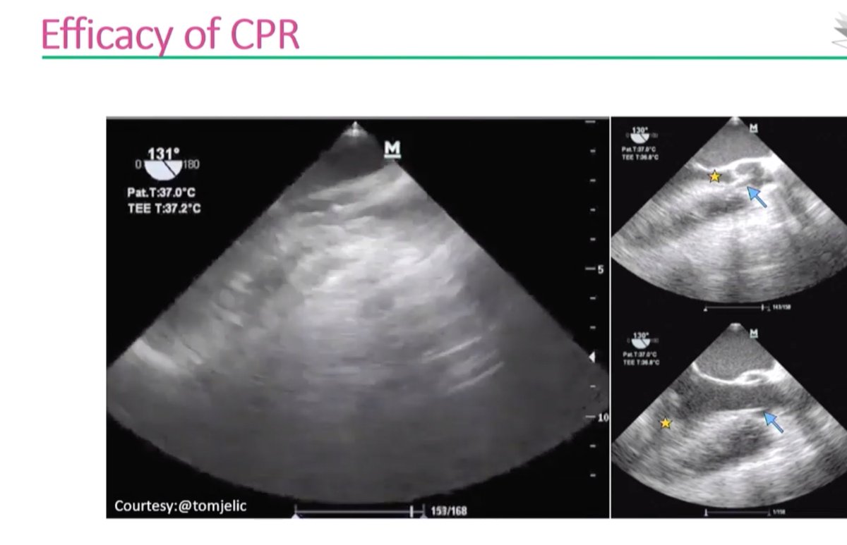 FOAMecmo's tweet photo. Critical care #echocardiography #TTE perceived easier/less invasive/more available, advantage for #TEE? complementary/live-saving ie CA trauma #ECMO #ECPR @docsanga @Smart_Meeting_M video https://t.co/xbOqvd6v8F #FOAMus
Join #SMARTmi2020 to meet Fabio & lot of amazing speakers! https://t.co/UYmPHGvHoO
