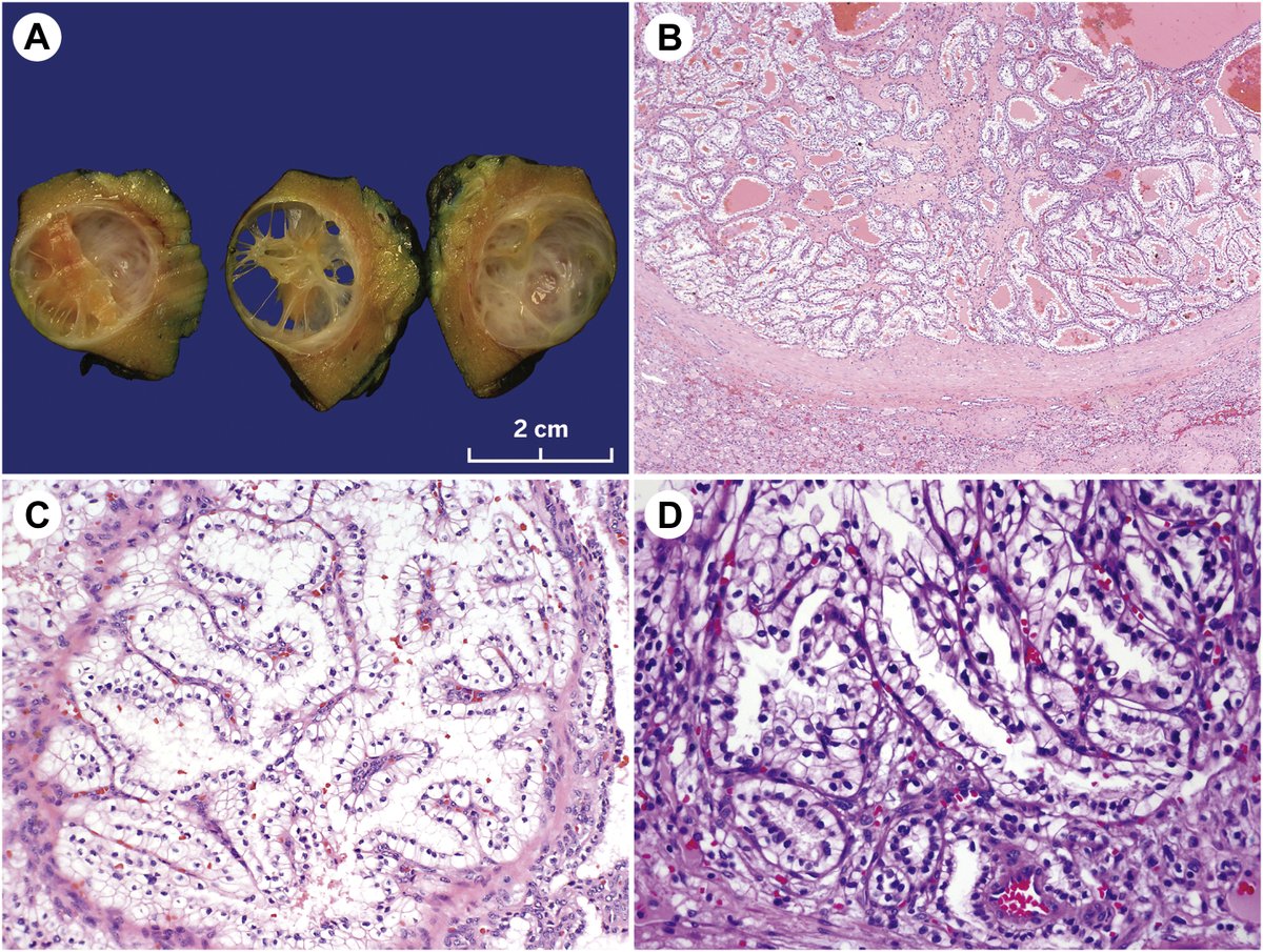 50 years of Urologic pathology. An absolute tour de force comprehensive review of GU pathology. From morphology to molecular and beyond!  It's all here!
The bigger the universe gets, the faster it gets bigger.
#GUPath #MolDx #Pathology #SurgPath #RenalPath
sciencedirect.com/science/articl…