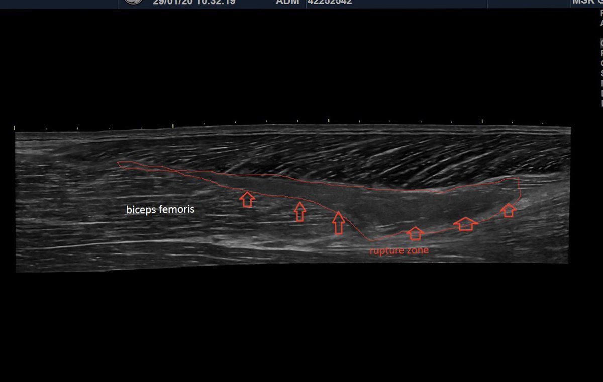 SportklinikBern's tweet photo. Grade 3B muscle tear of the biceps femoris during sprinting #muscletear #bicepsfemoris #sportsinjury #mskus #pocus #logicview #s7r3 https://t.co/jgAEhUrmSv