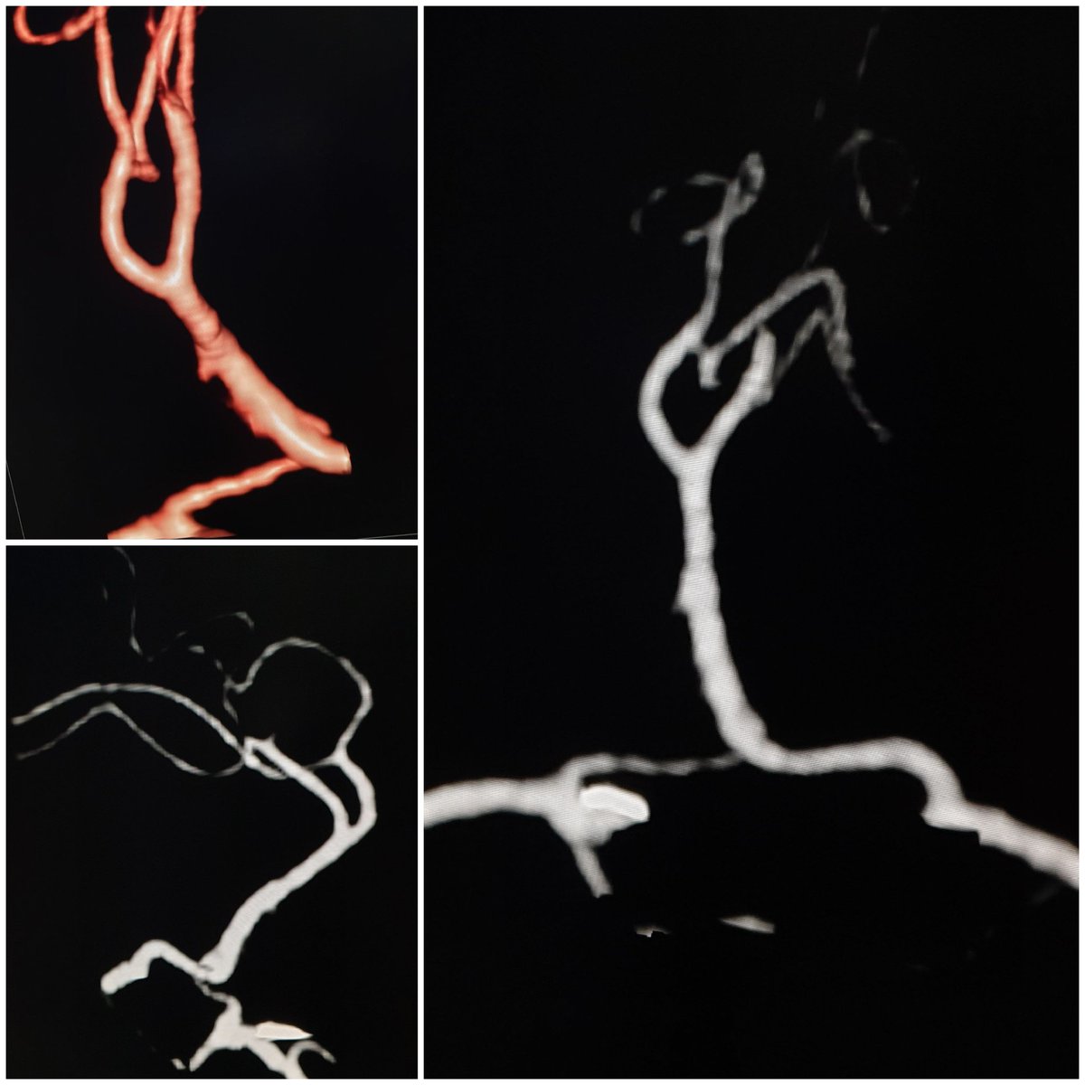neurovascu_lab's tweet photo. #anatomicalvariant

How would you describe this anatomical variant ?

@youngneurosurgeon @weareyoungnir @hopkinsneurorad @europeanneurologists @ESOstroke @UCLAStrokeINR @USCneurorads @mountsinaiir @neurosurgicalatlas @stanfordneuroi1 @GuenegoAdrien https://t.co/NSXHnp8McM