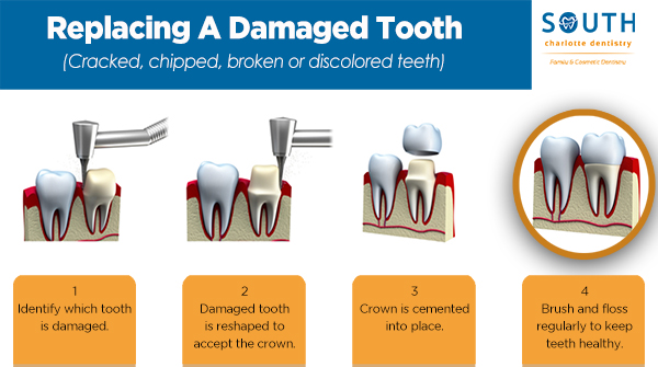 Replacing a damaged tooth can be easy done in our office in only 4 easy steps.
southcharlottedentistry.com/tooth-replacem…
#southcharlottedentistry #tooth #damagedtooth #crown #crackedtooth #chippedtooth #brush #floss #clt #queencity #bestdentistincharlotte