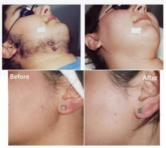 Permanent Hair Removal With Ayurveda  Boldskycom