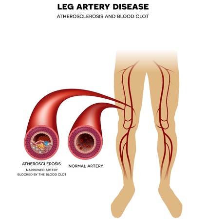 Your Painful Feet May Be a Warning of Heart Disease! ow.ly/9CL150y8b2s #PAD #arteries