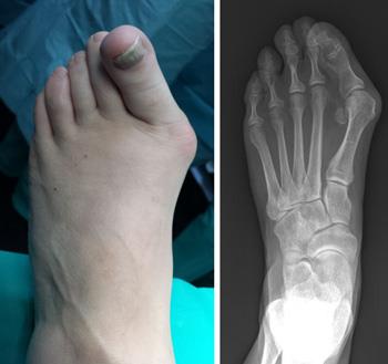 Yorkshire_Foot's tweet photo. Now you can see the reason why a #Bunion hurts so much!
We can help, speak to our expert team today.
.
#yfh #Leeds #Painfree https://t.co/0t9DYkYy7O