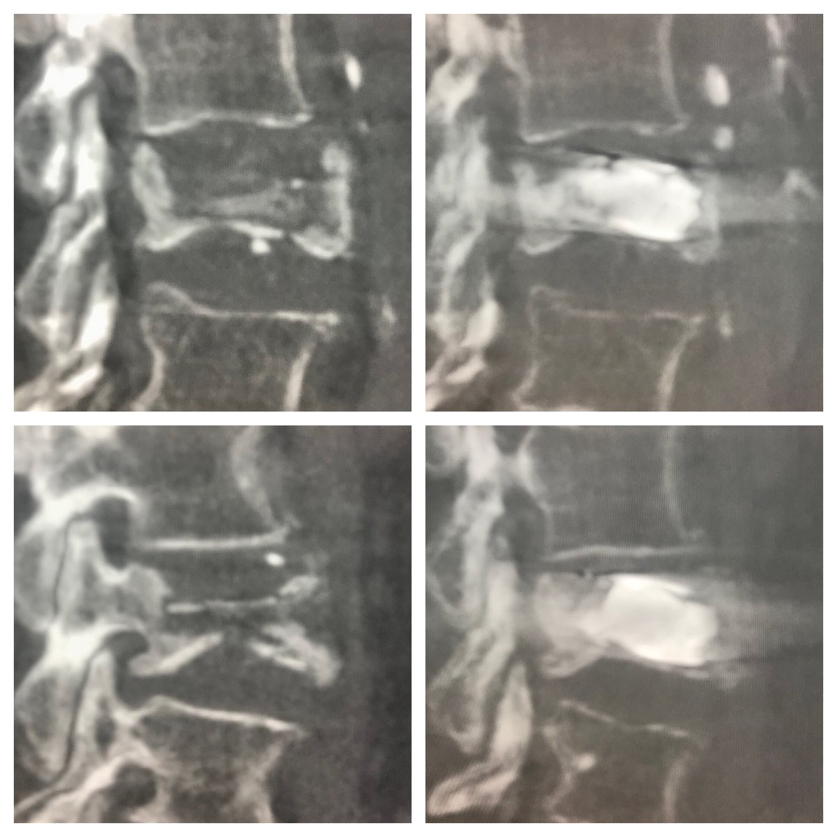 Safet Lekperic MD, RPVI (@safet_md) on Twitter photo L3 vertebra plana s/p 5.0 mm #SpineJack Implant providing symptomatic relief with controlled anatomical restoration - showing reduction in retropulsion on many of our cases <a href="/ImagingDoctor/">Dana Dunleavy, MD</a> <a href="/dougbeall/">Douglas Beall</a> <a href="/spine_jack/">SpineJack</a> <a href="/SIRRFS/">SIR RFS</a> <a href="/WayneOlan/">Wayne Olan</a> <a href="/Brett_Maloney/">Brett Maloney</a> L3 vertebra plana s/p 5.0 mm #SpineJack Implant providing symptomatic relief with controlled anatomical restoration - showing reduction in retropulsion on many of our cases <a href="/ImagingDoctor/">Dana Dunleavy, MD</a> <a href="/dougbeall/">Douglas Beall</a> <a href="/spine_jack/">SpineJack</a> <a href="/SIRRFS/">SIR RFS</a> <a href="/WayneOlan/">Wayne Olan</a> <a href="/Brett_Maloney/">Brett Maloney</a>
