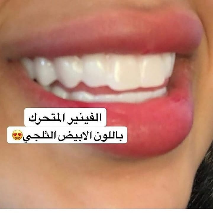 diaazm12's tweet photo. #خالد_الغنام_نصراوي

نقدم لكم  عروض على ابتسامة متحركة 
 في جدة ورياض ابها جيزان و نجران والمدينة

١٢٠٠ريال بدل ١٥٠٠ريال حتى ٢٠٢٠/٢/١٠

1_بدون تحضير الاسنان .
2-بدون تصغير وبرود الاسنان .
3-تصليح شكل الاسنان الغير منتظمة.
4-إغلاق كامل الفراغات بين الاسنان 
5-تعويض الاسنان المفقود https://t.co/LO5K3rO7ON