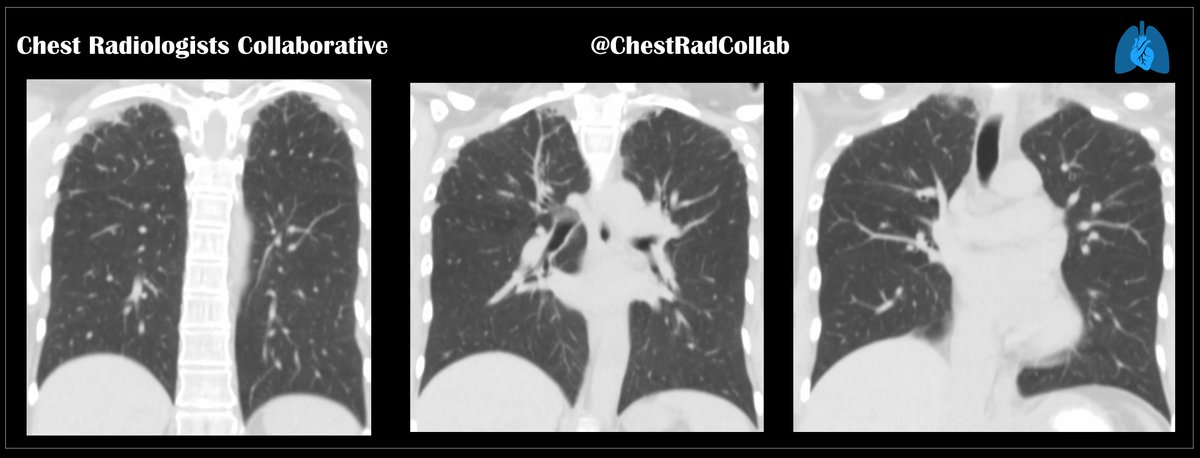 chestradcollab's tweet photo. @howardm19 @JeffreyKanneMD 

STR webinar tomorrow

A surgical lung biopsy was performed for a “suspicion of ILD.”

A geologist for ~ 15 years, sometimes working at mining sites. No details about the type of mining. No family history of ILD.

What’s a likely pathologic diagnosis ? https://t.co/uWEWM4hWtv