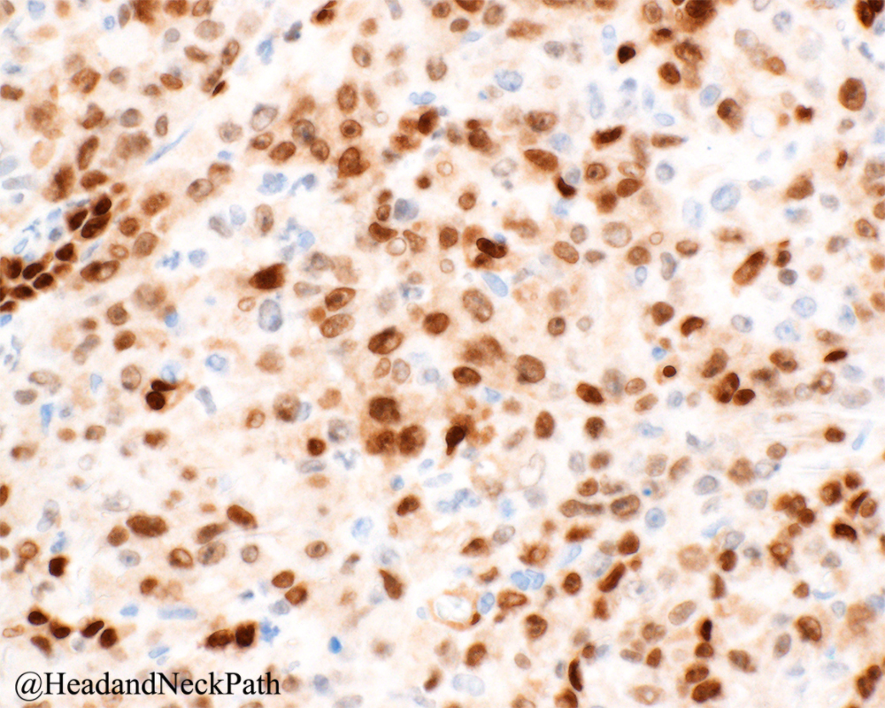 Soft Tissue Special Issue: Cutaneous Pleomorphic Spindle Cell Tumors by Dr. Thomas Brenn.
rdcu.be/b0WcY
#HeadNeckPathol #HNPJ #HeadandNeckPath #Pathology #ENTPath #PathologyTweet
