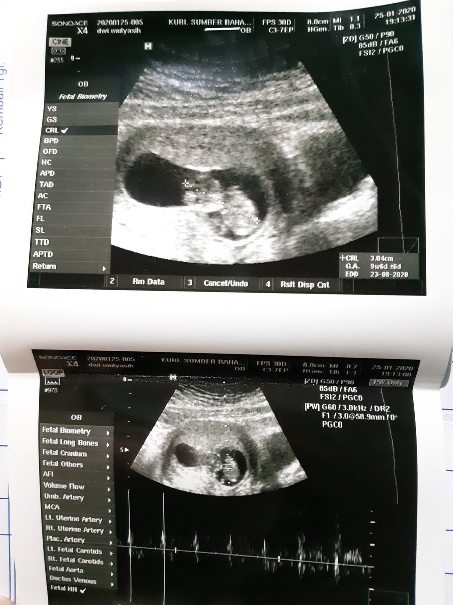 Kontrol hari sabtu kemarin rasanya campur aduk , mau teriak heboh gak enak sama bu dokter and suster , entah rasanya gak bisa diungkapin
MasyaAllah , pas lihat jantungnya berdenyut , Alhamdulillah janinnya berkembang, sehat2 ya dek 🤲🏻😭😊