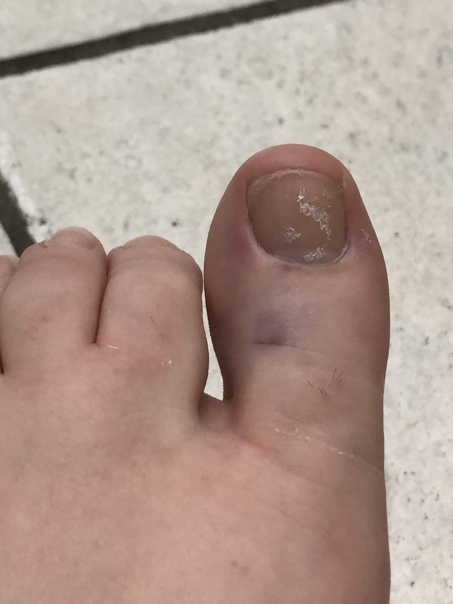 abbysname's tweet photo. For the next 9-12 weeks this Twitter account is dedicated to whining and moaning about how much my toe hurts. #UghAgain https://t.co/WDqjtB99s7