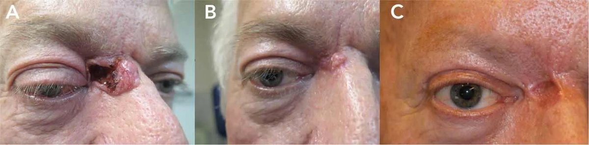 Now online: Vismodegib for periocular basal cell carcinoma: an international multicentre case series
#ophthalmology buff.ly/36BiBIT